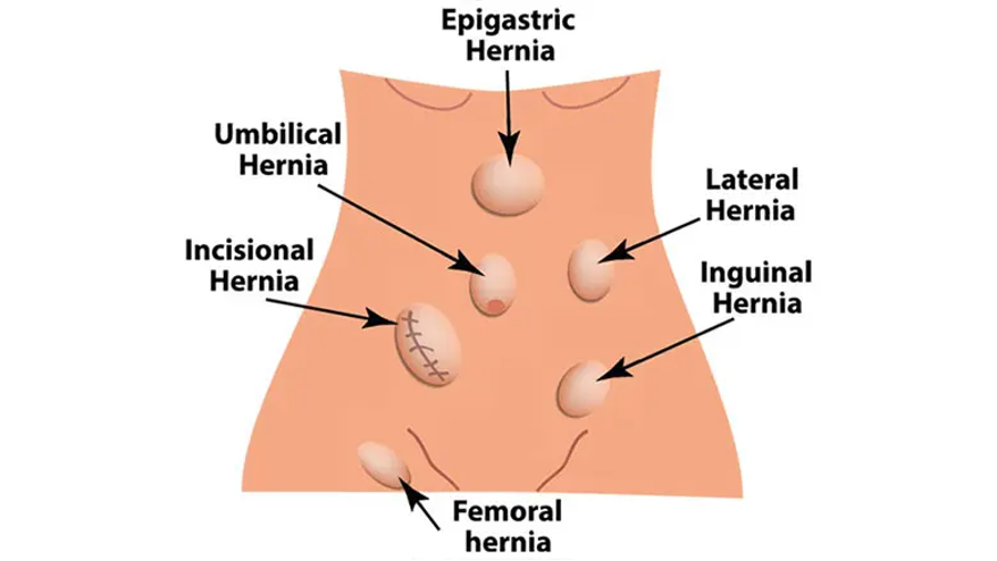 Abdominal-Wall-Hernia