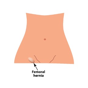 Femoral-Hernia