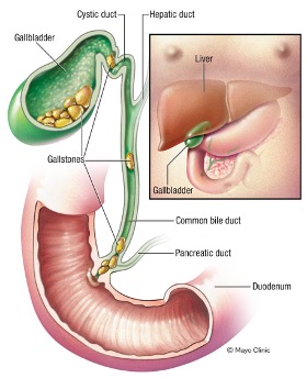 GALLSTONES-treatment-in-dubai