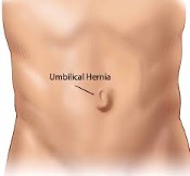 Umbilical-Hernia