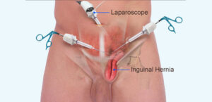 Laparoscopic-Vs.-Open-Hernia-Repair