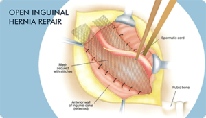 sa-hernia-inside-1