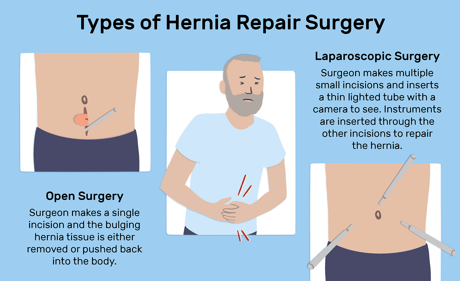 Hernia Treatment