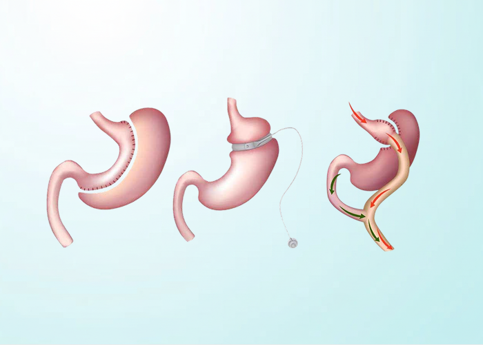 Laparoscopic Surgery