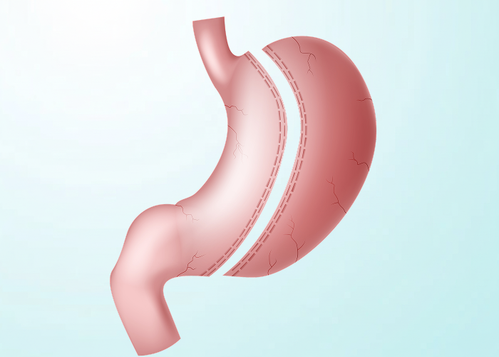 Gastric Sleeve surgery in dubai