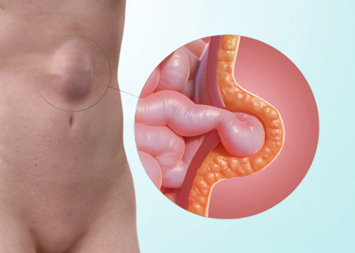 Ventral Hernia
