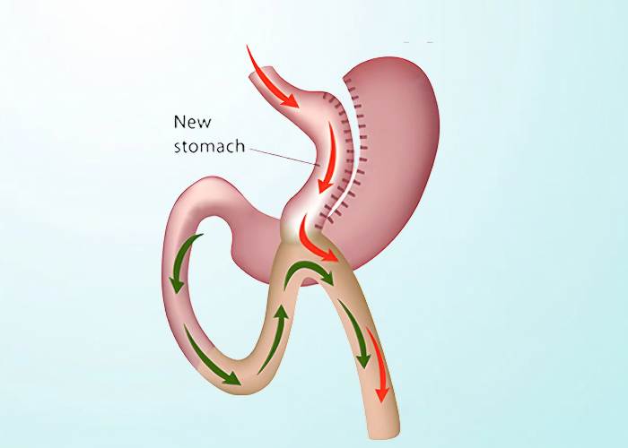 Mini Gastric Bypass in dubai