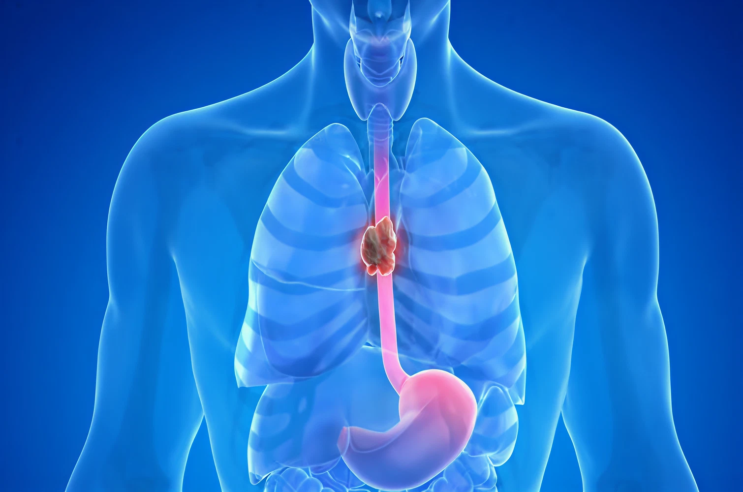 Esophageal Cancer Surgery