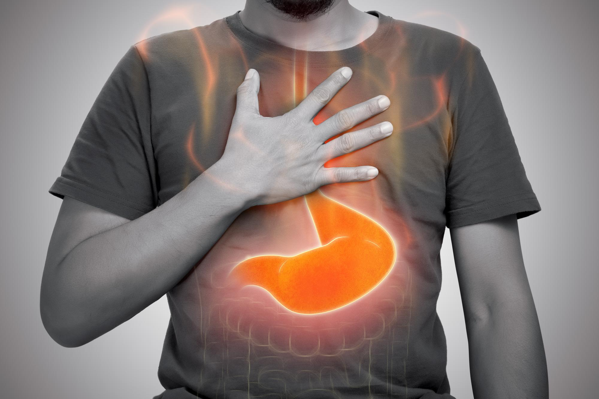 GERD / Acid Reflux