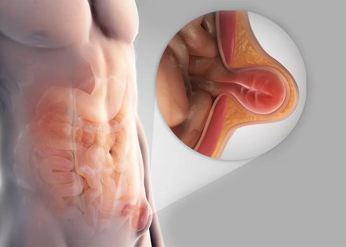 Incisional Hernia