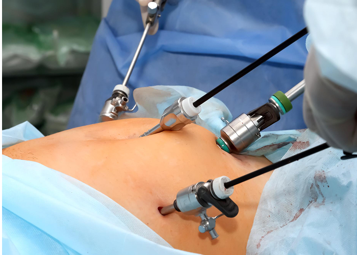 Laparoscopic Surgery