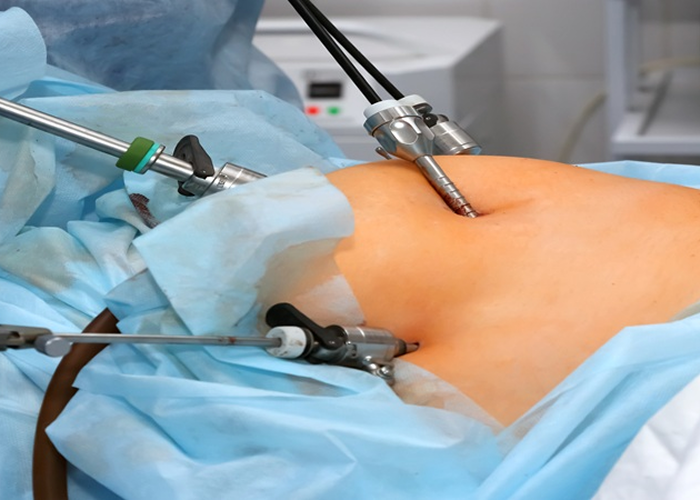 Laparoscopic Surgery