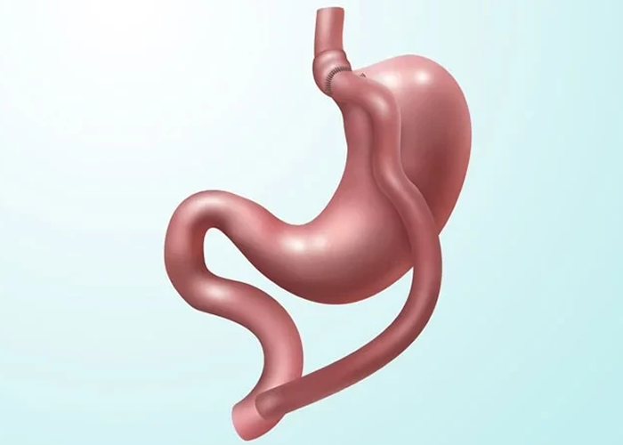Gastric Bypass