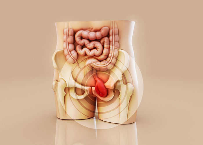 Inguinal Hernia